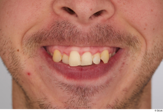 Joel teeth 0001.jpg